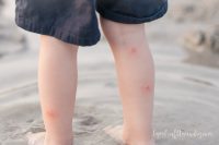 close up red itchy bites on toddler boy's legs